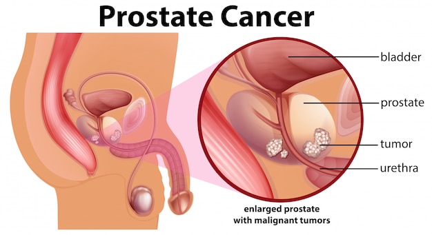 Resultado de imagen para cancer de prostata