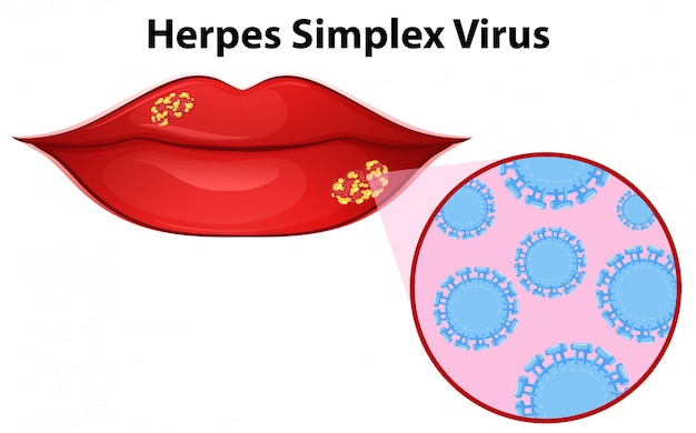 Diagrama Que Muestra El Virus Del Herpes Simple Vector Premium