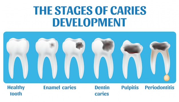 Las Etapas Del Desarrollo De La Caries Vector Premium 1661