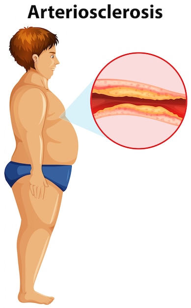 la arteriosclerosis