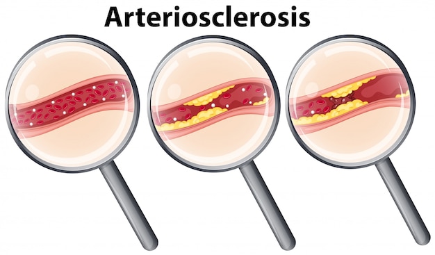 Humanos Con Arterioesclerosis Magnificada Vector Premium   Humanos Arterioesclerosis Magnificada 1308 15418 