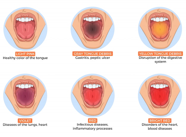 Ilustracion Del Diagnostico De Diferentes Enfermedades Por El Color De La Lengua Vector Premium 6808