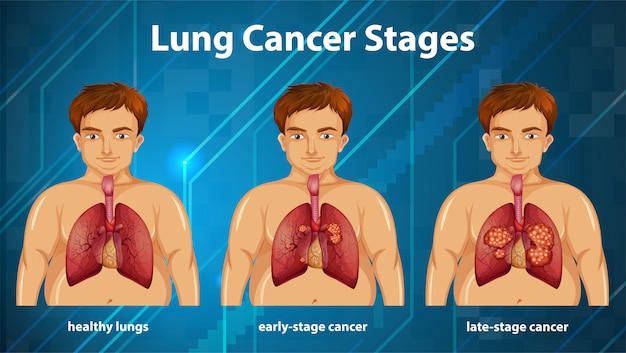 Las Etapas Del Cancer