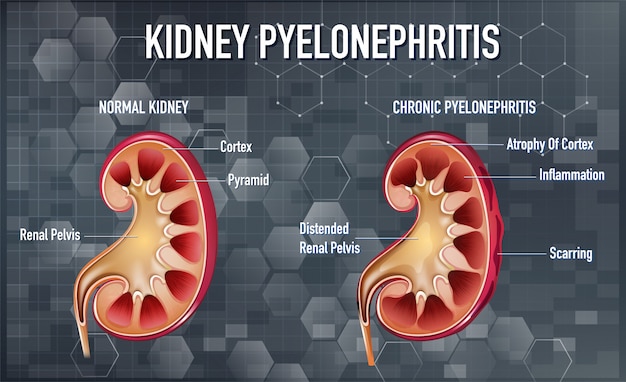 Ilustración Informativa De Pielonefritis | Vector Gratis