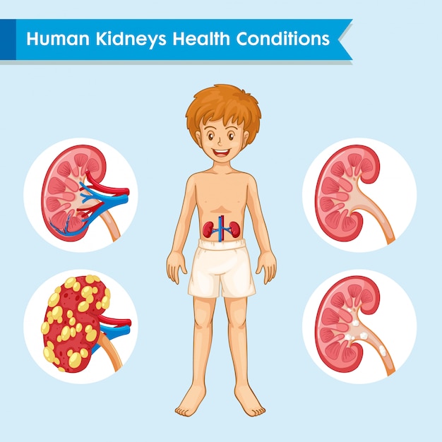 Ilustración Médica Científica De La Enfermedad Renal Vector Premium 5240