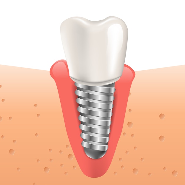 Ilustración realista de implante dental en gráfico 3d | Vector Premium