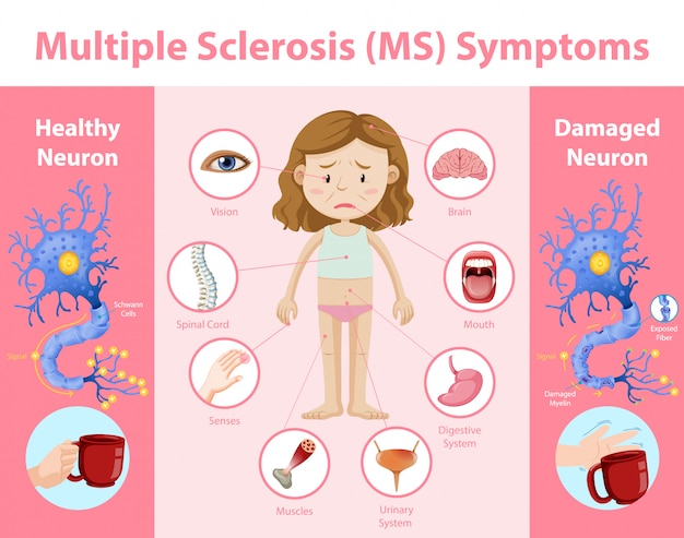 Infografia De Informacion De Sintomas De Esclerosis Multiple Em Vector Gratis