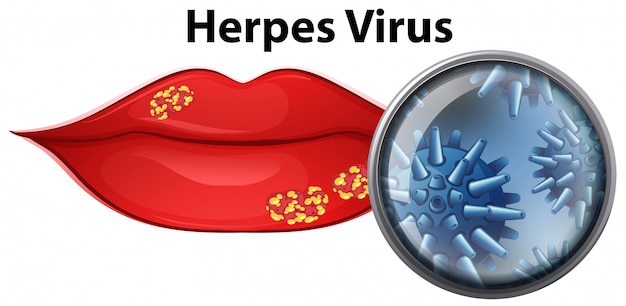 Imágenes De Herpes Virus Vectores Fotos De Stock Y Psd Gratuitos 7362