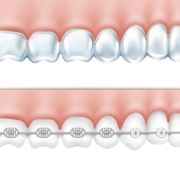 Vector De Dientes Humanos Con Aparatos De Metal Y Vista Lateral De La Bandeja Blanqueadora Aislada Sobre Fondo Blanco Vector Gratis