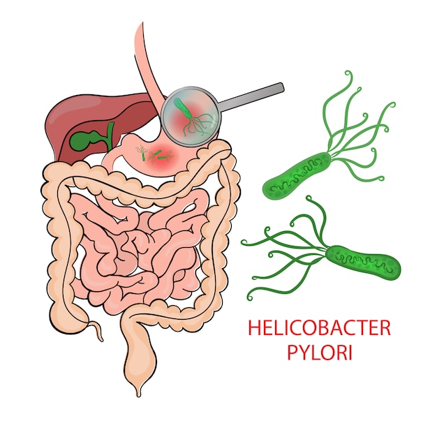 Helicobacter pylori ассоциированное заболевание показания и схемы антихеликобактерной терапии