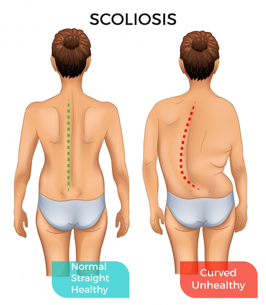 Normale Gesunde Wirbelsaule Und Gekrummte Wirbelsaule Mit Skoliose Premium Vektor