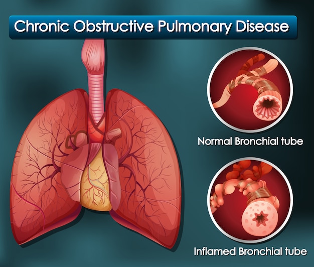 Diagrama Mostrando Doen A Pulmonar Obstrutiva Cr Nica Vetor Gr Tis