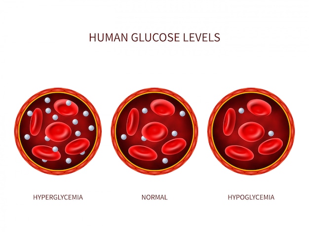 N Veis De Glicose Humanos Hiperglicemia Normal Hipoglicemia Vetor Premium