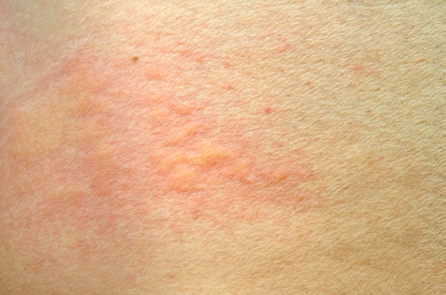 Huiduitslag Urticaria Allergische Huidreactie Premium Foto