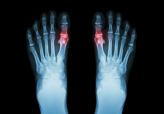 ambitie strak convergentie Jicht, reumatoïde artritis. film x-ray zowel voet als artritis | Premium  Foto