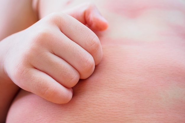 Weinig Aziatische Handkras Van Het Babymeisje Op Haar Lichaam Met Jeukende Huiduitslag En Allergie Premium Foto