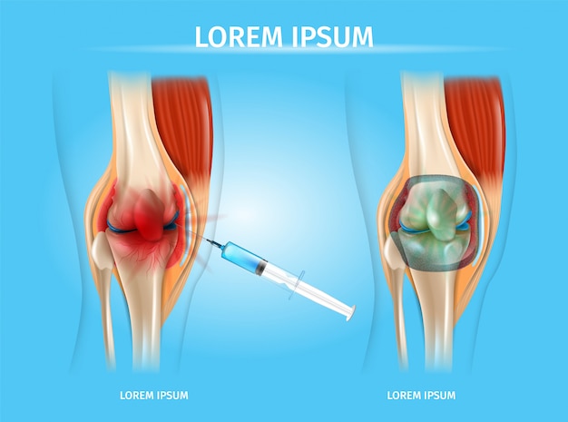 Therapeutische blokkering met injectietherapie vector Premium Vector